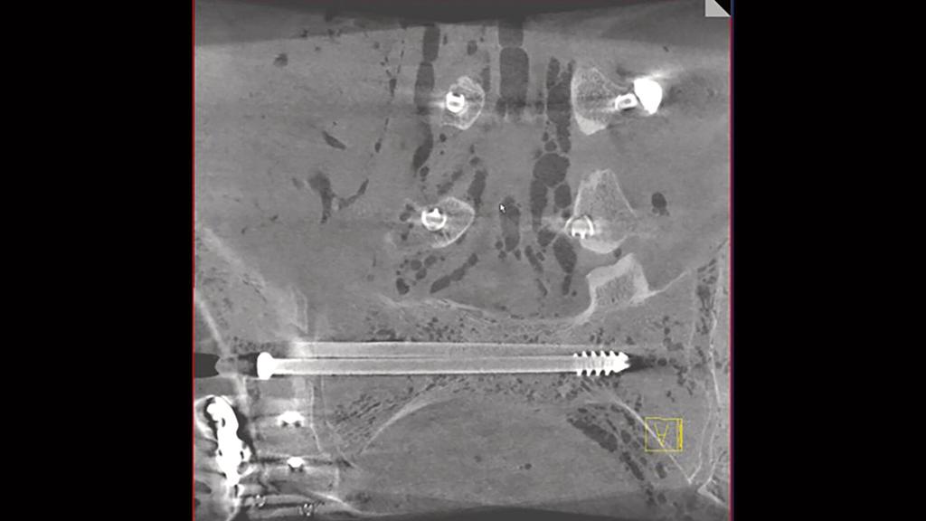 Tibia Zoom Intraoperative 3D imaging in orthopedic trauma surgery - Siemens ...