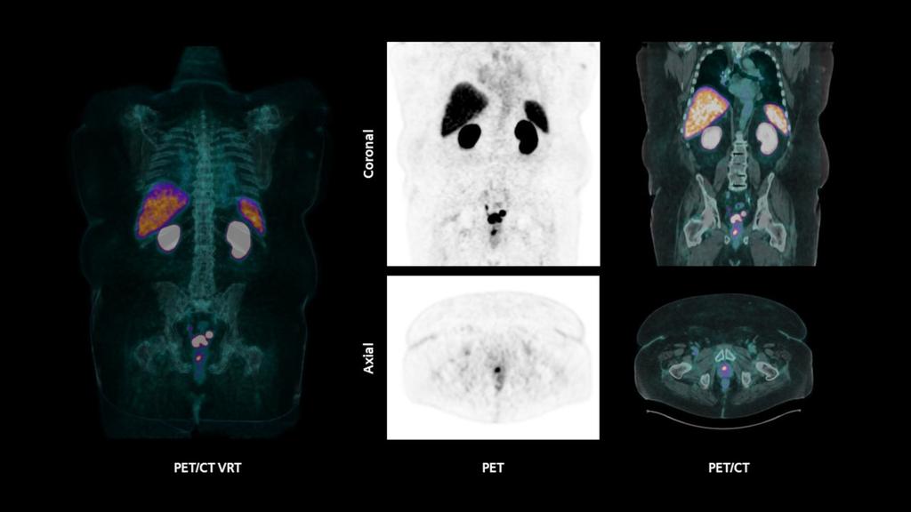 Biograph Trinion PET/CT scanner - Siemens Healthineers