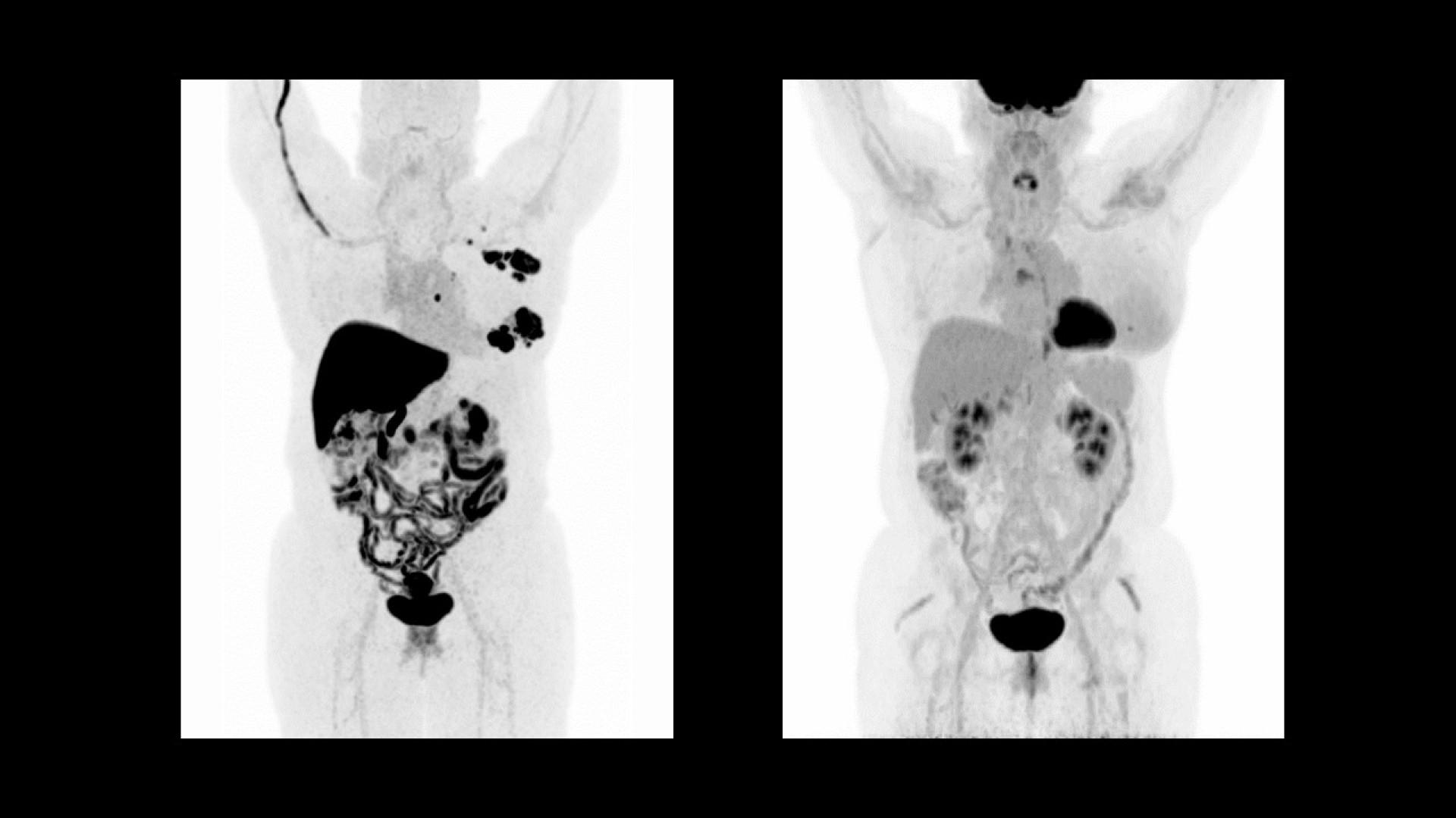 18F-FES PET/CT distinction of ER-positive lesions in a