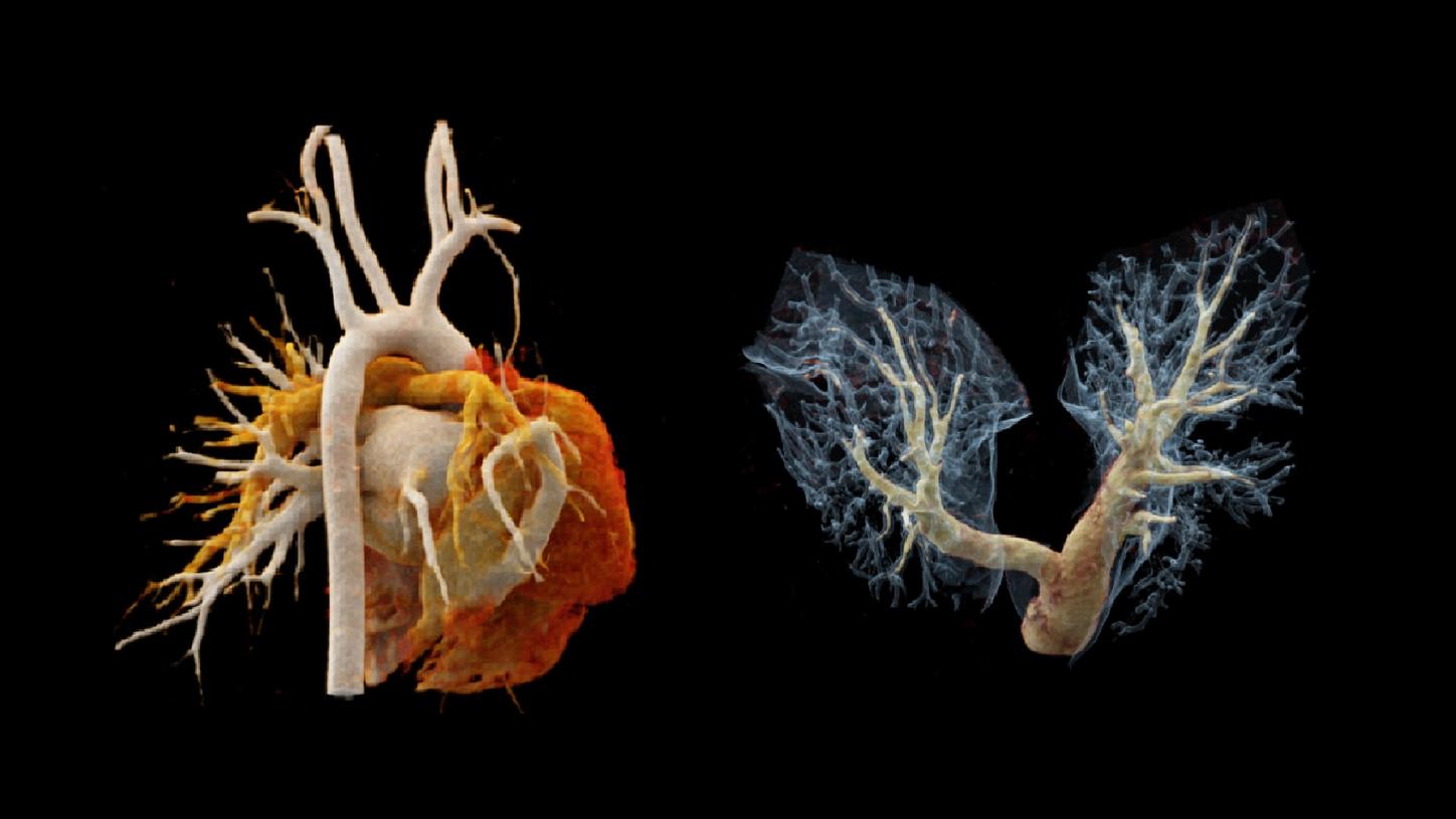 Two cVRT images show a PARPV draining into the upper part of the IVC, a RIPV, of small caliber, returning into the LA, and a hypoplastic RPA.