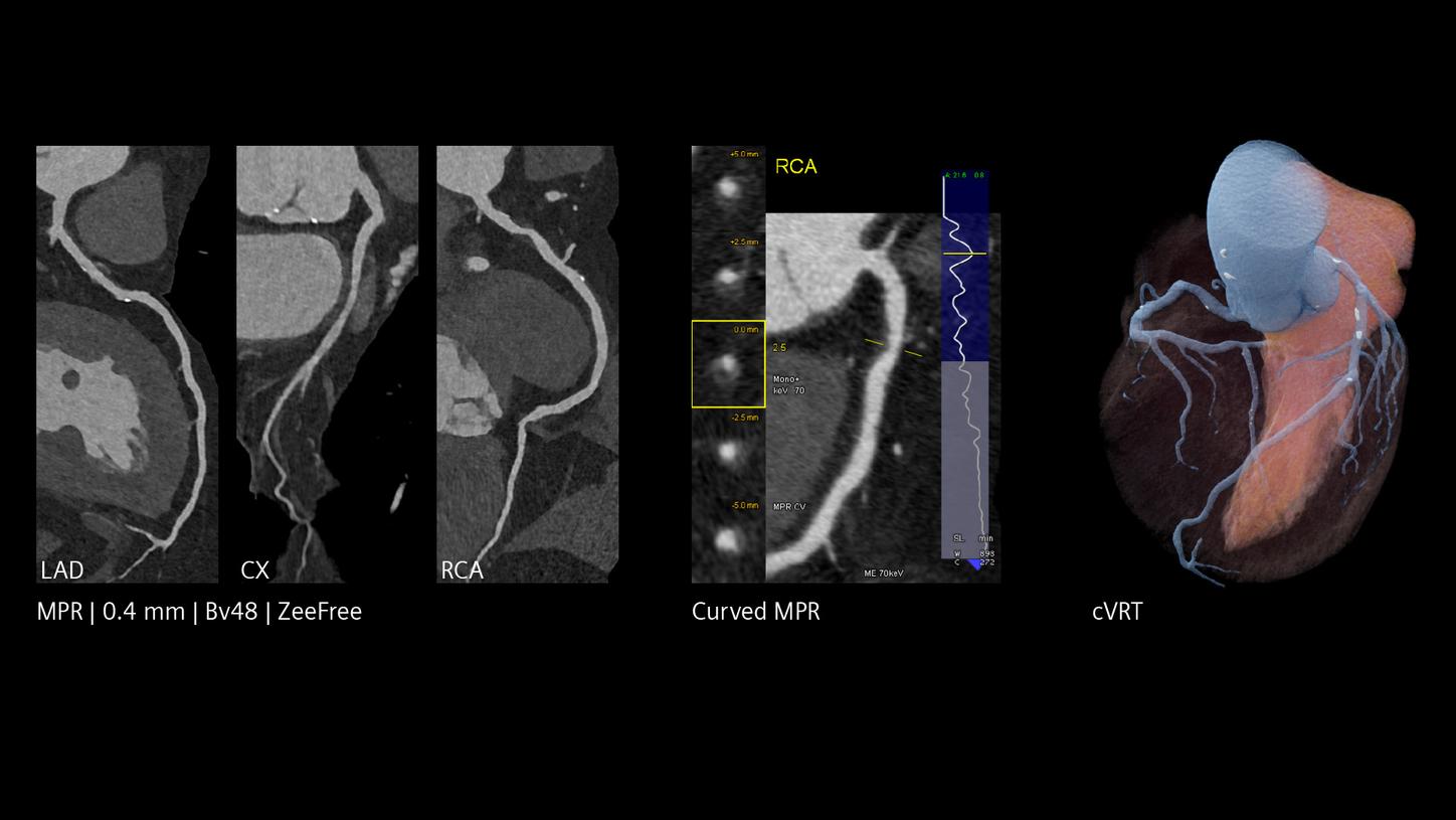 CT images of coronary arteries with curved and 3D reconstructions