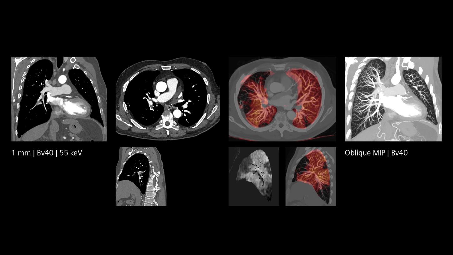 The combination of morphological and functional information provides pulmonary embolism assessment in one scan.