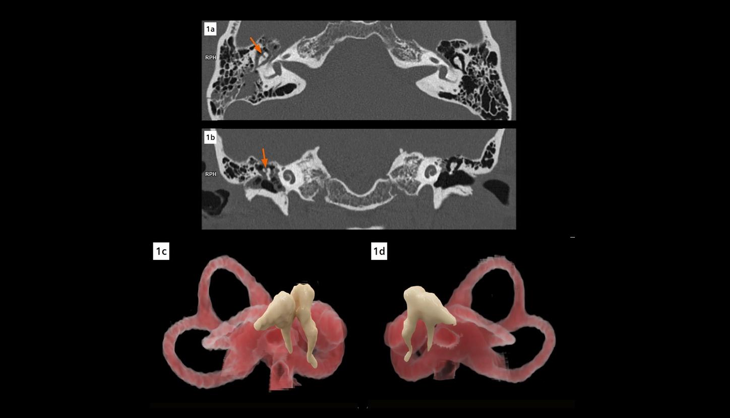 An axial image shows displacement of the head of the malleus from the body and short process of the incus on the right. A typical “broken heart” sign is seen in a coronal MPR image. Two cVRT images created with thin slices demonstrate the incudomalleolar dislocation in three dimensions.