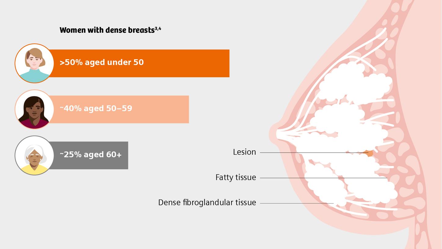 Graphic showing dense breast tissue – a challenge for cancer detection