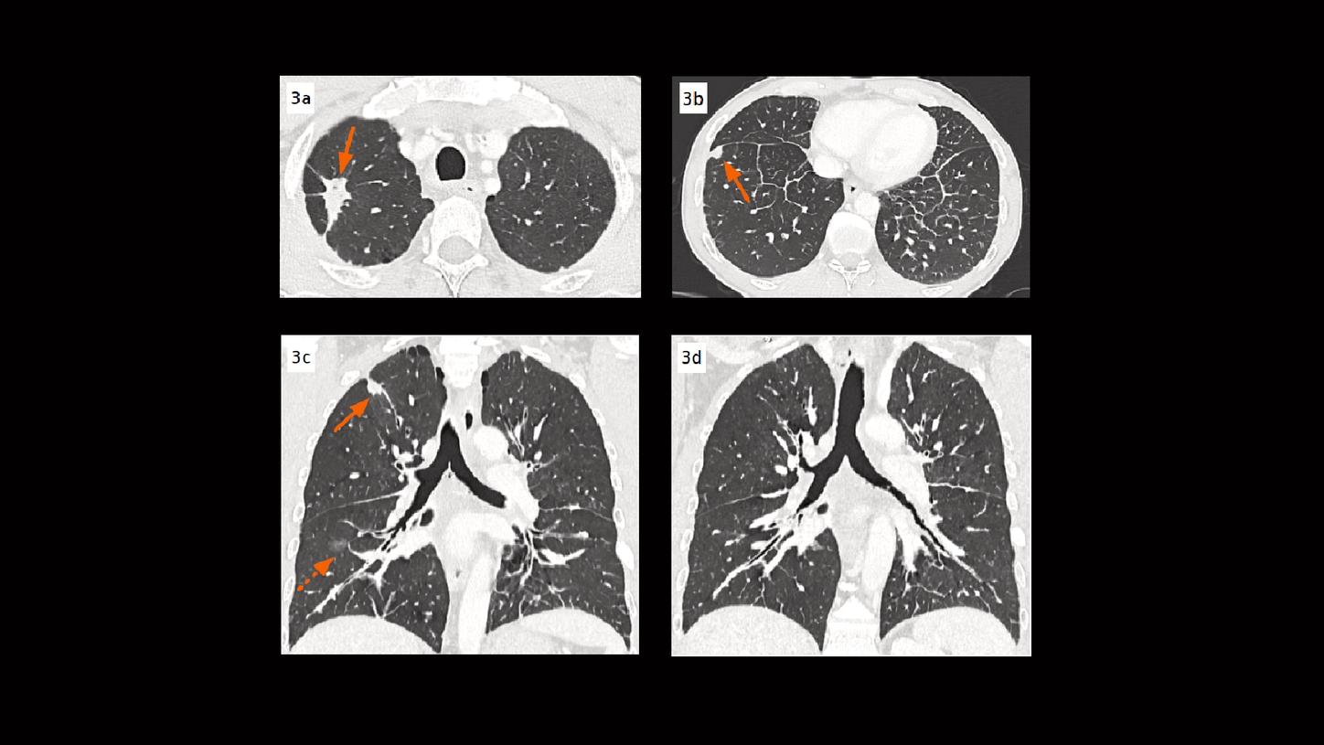 Axial images and coronal MPR images show lung nodules in the right upper and lower lobes. A small area of consolidation is also seen in the right lower lobe. Both central and peripheral lymphangitic carcinomatosis are visualized.