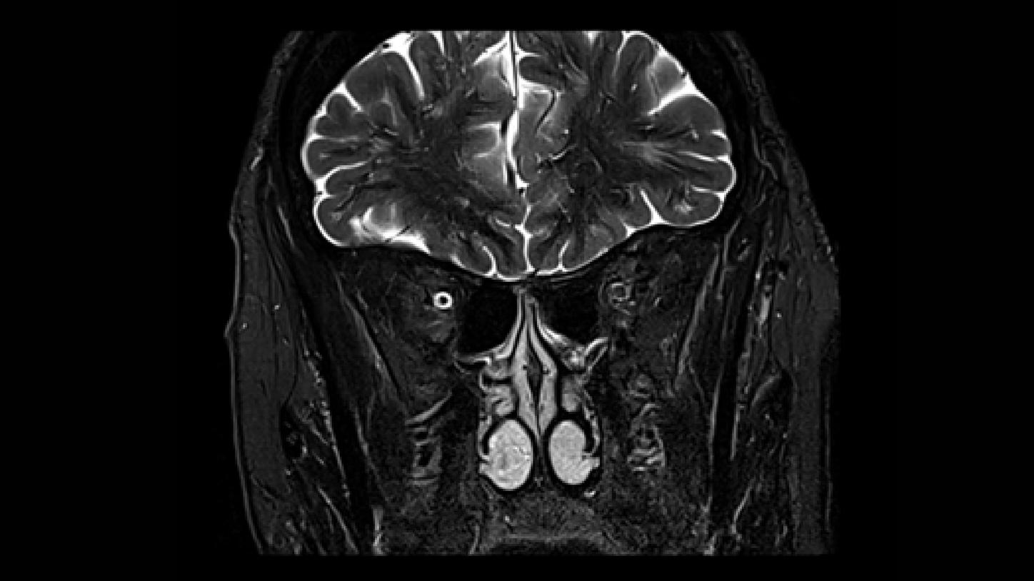 CT image of retro-ocular masses causing exophthalmos along with bilateral perinephric, pericardial, and pelvic exudates