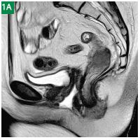 Case Report &quot;MAGNETOM Avanto Recurrent Rectal Cancer Evaluation with VIBE and SPACE&quot;Bild1A