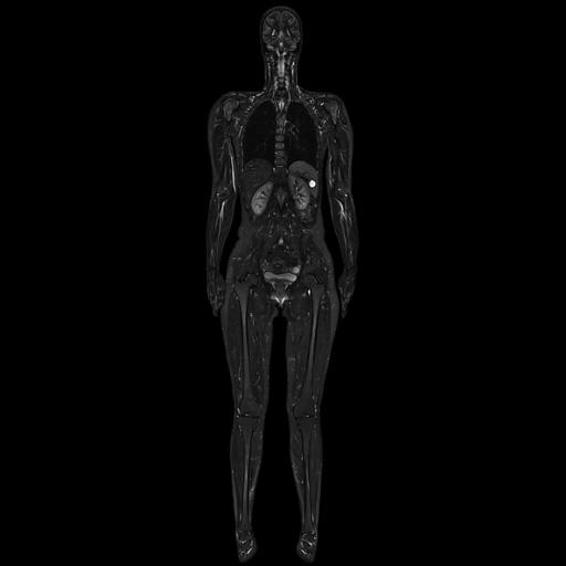 Composed coronal whole-body TIRM scan