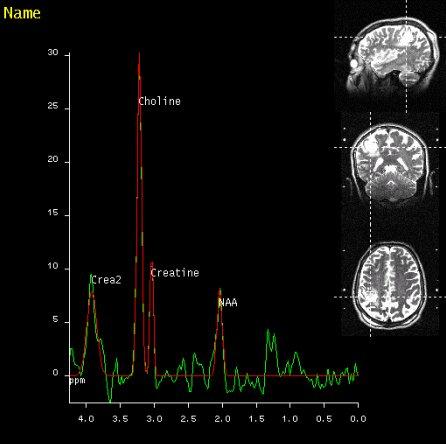 SVS shows increased Choline signal in the lesion of the right temporal lobe, proving malignancy