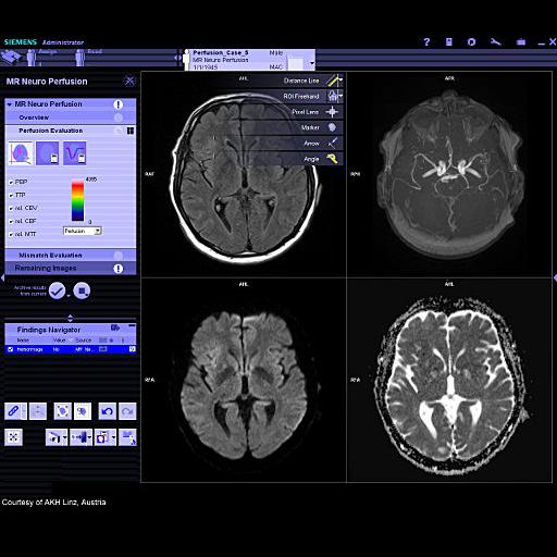 syngo.MR Neuro Perfusion Engine