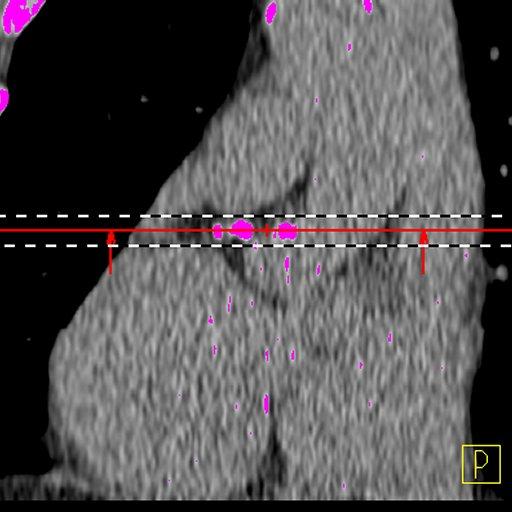 syngo Calcium Scoring