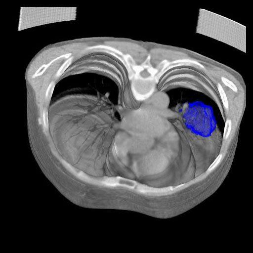 syngo Dual Energy Lung Nodules