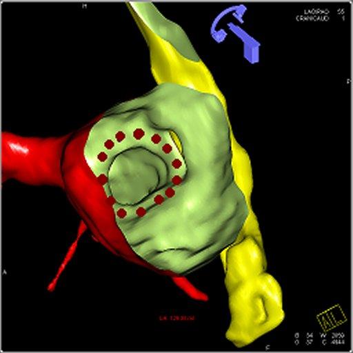 syngo Electrophysiology Guidance