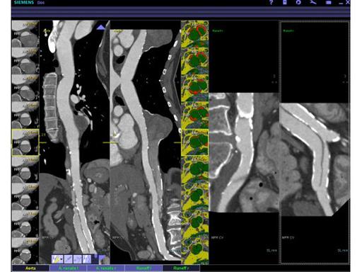 syngo.CT Vascular Analysis - Siemens Healthineers