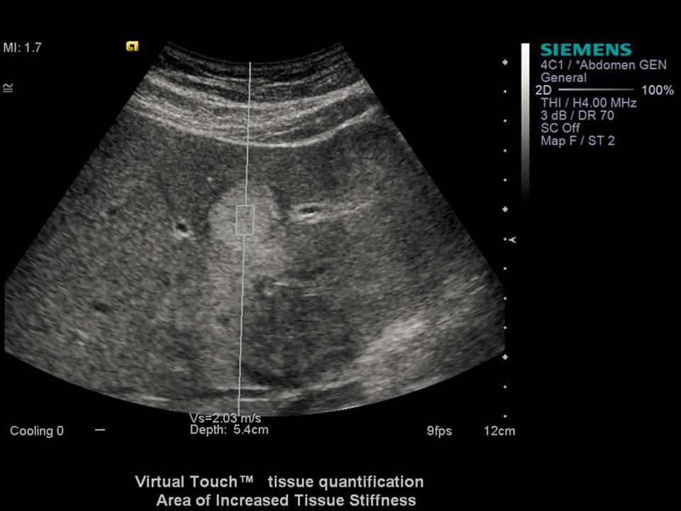 Area of Increased Tissue Stiffness<br />