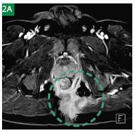 Case Report &quot;Case Report MAGNETOM Avanto Complicated Rectal Fistula&quot;