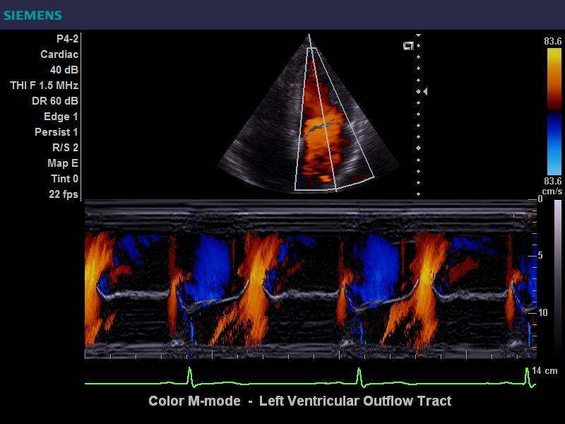 ACUSON Antares - Cardiology/Cardiovascular - Heart