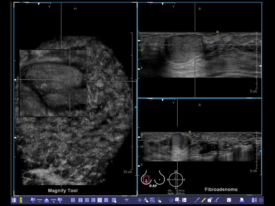 ACUSON S2000 ABVS - Women's Health - Volumetric