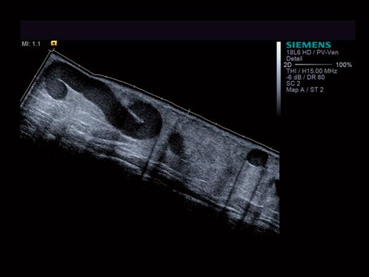 ACUSON S3000 Ultrasound System - Vascular - SieScape panoramic imaging