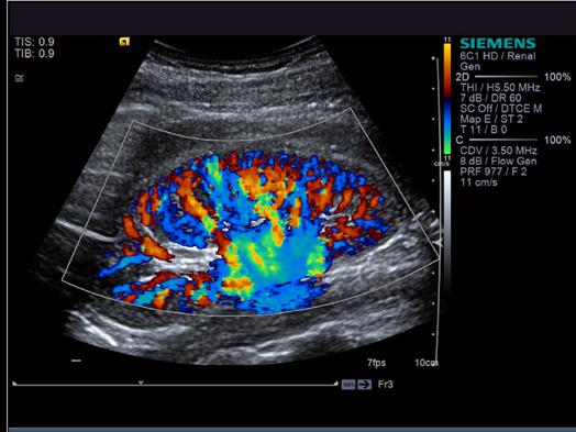 ACUSON S3000 Ultrasound System - Abdominal - HD Transducers - 18L6HD Transducer