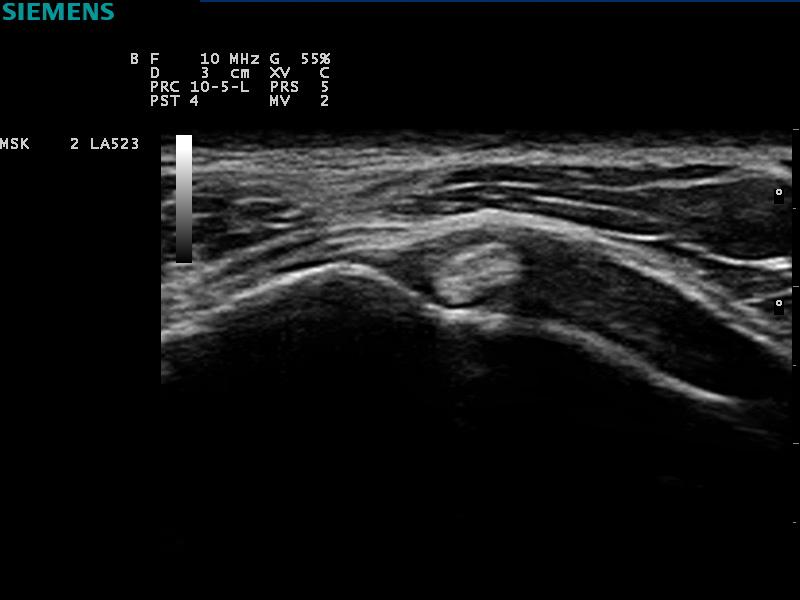 ACUSON P300 Ultrasound System - MSK - Biceps Tendon