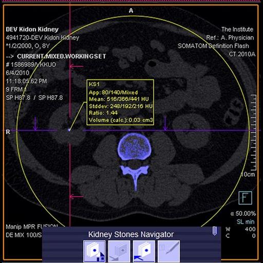 syngo.CT DE Calculi Characterization - Siemens Healthineers
