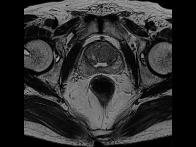 MAGNETOM MRI Scanner Systems: Siemens’ 3 Tesla systems yield excellent resolution even with external coils only (no endorectal coil).