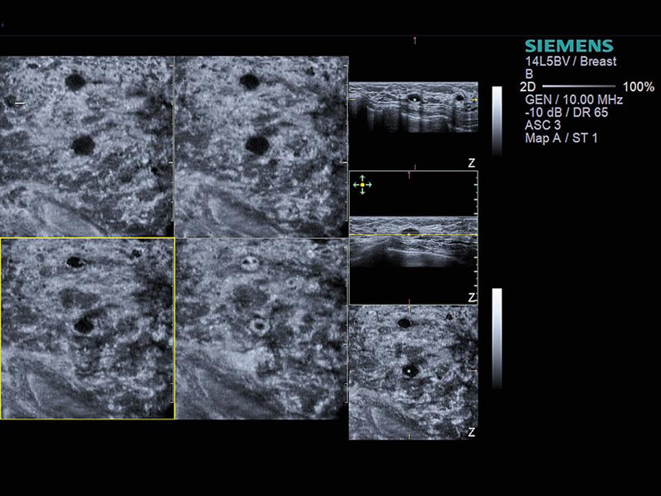 Early detection ultrasound, dense breasts