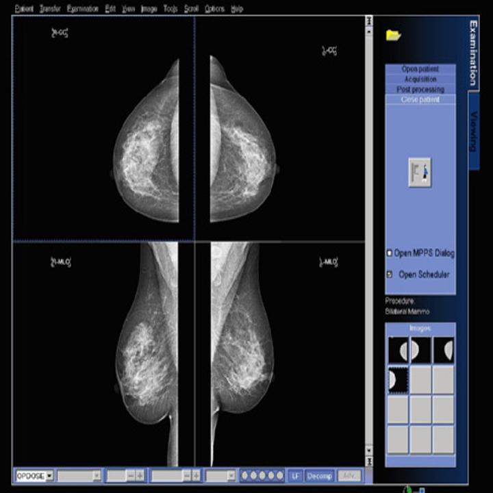 Early detection mammography