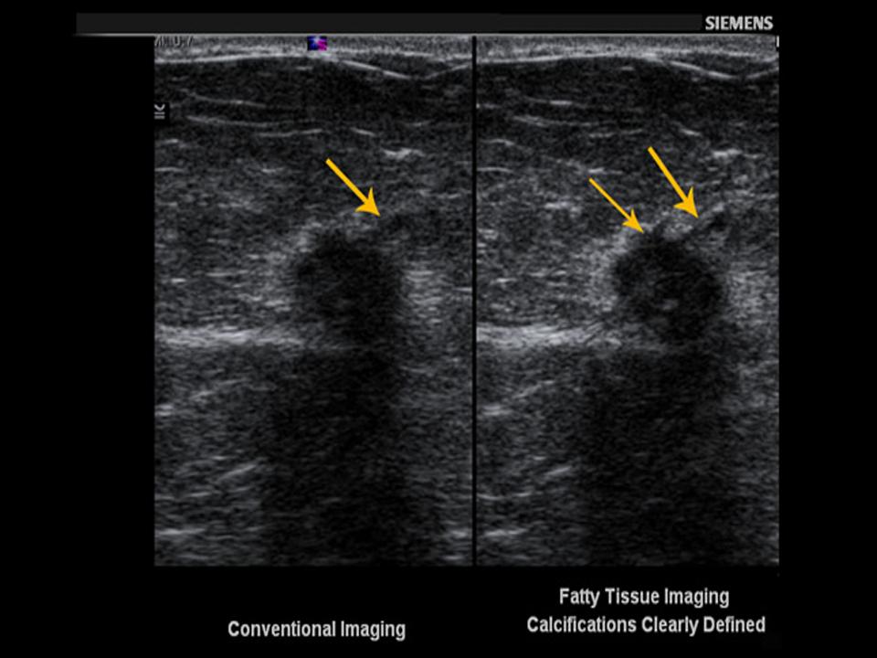 Fatty tissue imaging