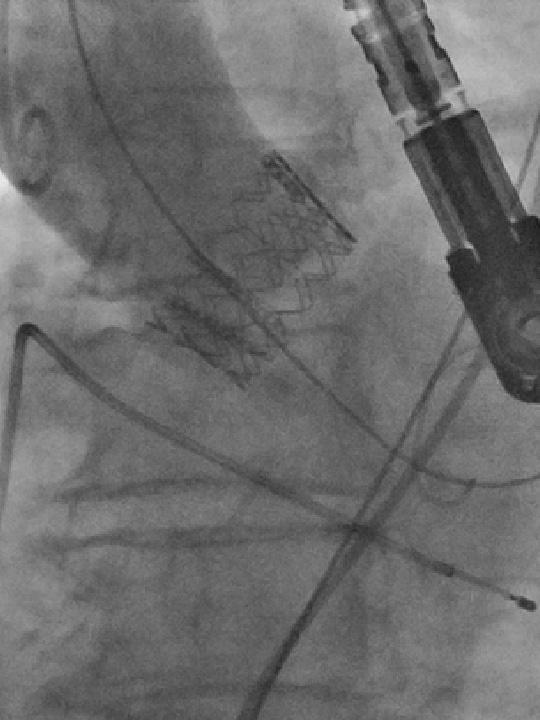 structural heart disease