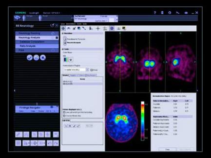 syngo.SPECT Striatal Analysis