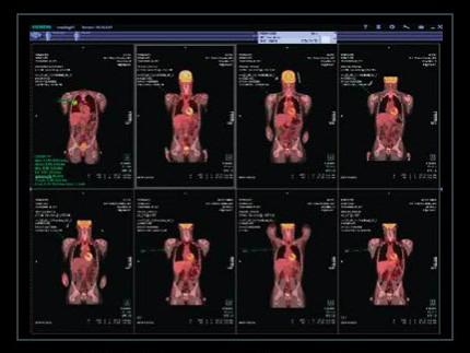 syngo.PET&amp;CT Onco Multi-Timepoint