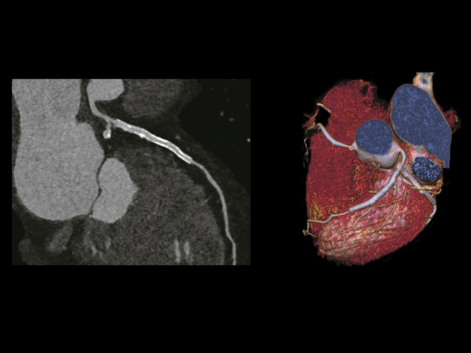 CT Scanner SOMATOM Force Turbo Flash Coronary CTA