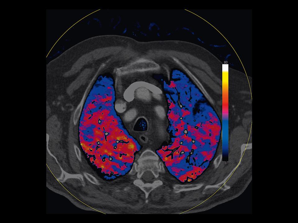 CT Scanner SOMATOM Force DE Lung PBV