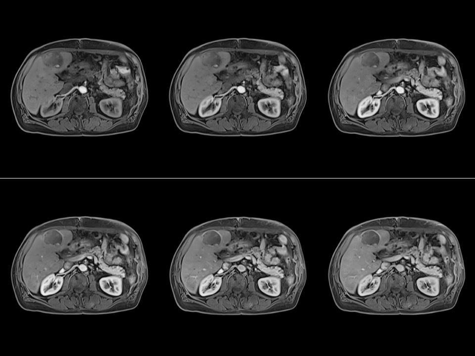 MRI - Clinical Applications - FREEZEit - TWIST-VIBE