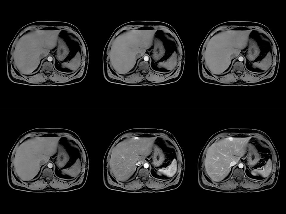 MRI - Clinical Applications - FREEZEit - TWIST-VIBE