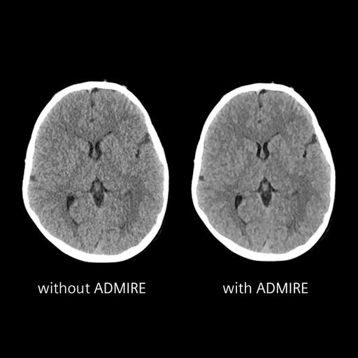 SOMATOM Definition Edge