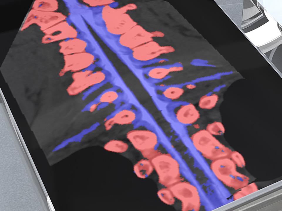 Computed Tomography Scanner True Dual Energy