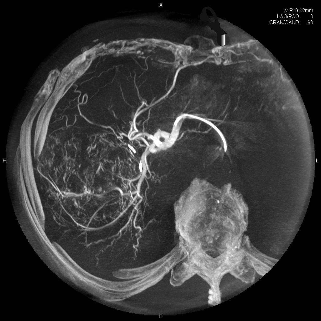 Projeção de intensidade máxima (MIP) para avaliação de alimentadores de tumor, syngo DynaCT