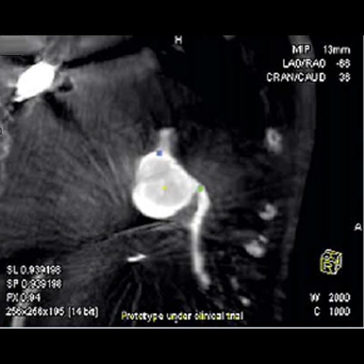 Siemens - Advanced Therapies - Case Study - Aortic Valve Implantation