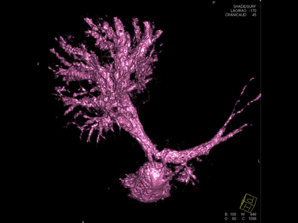 Complex Pulmonary Anatomy