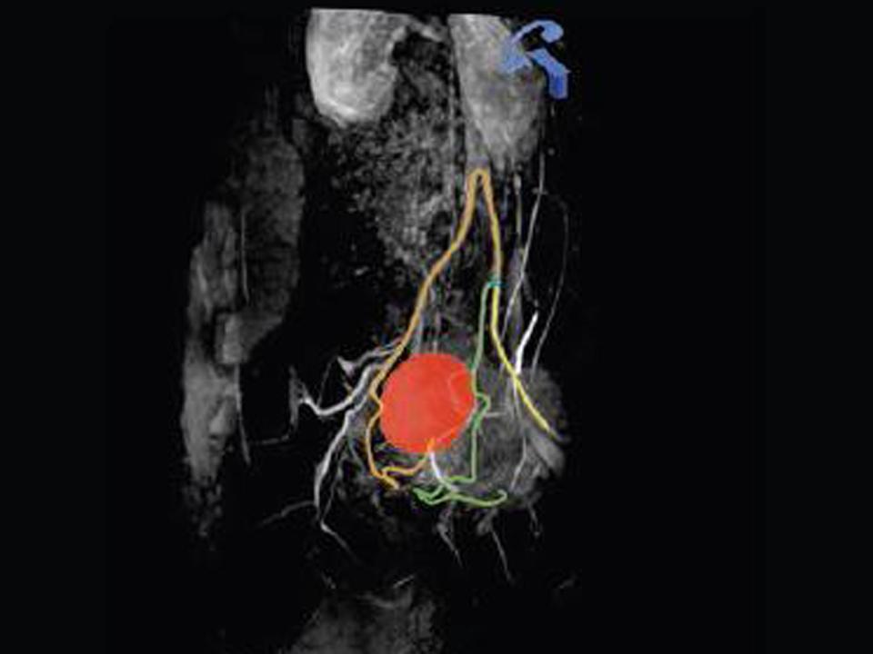 syngo Embolization Guidance