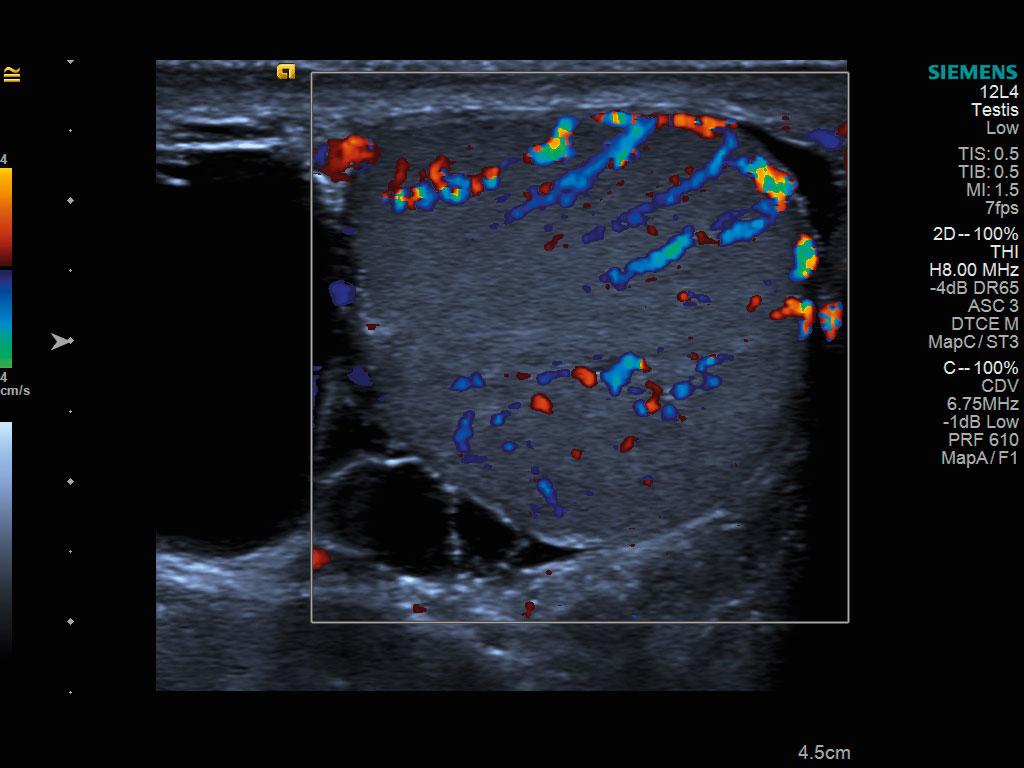 Doppler couleur d'une testicule avec hydroc&egrave;le