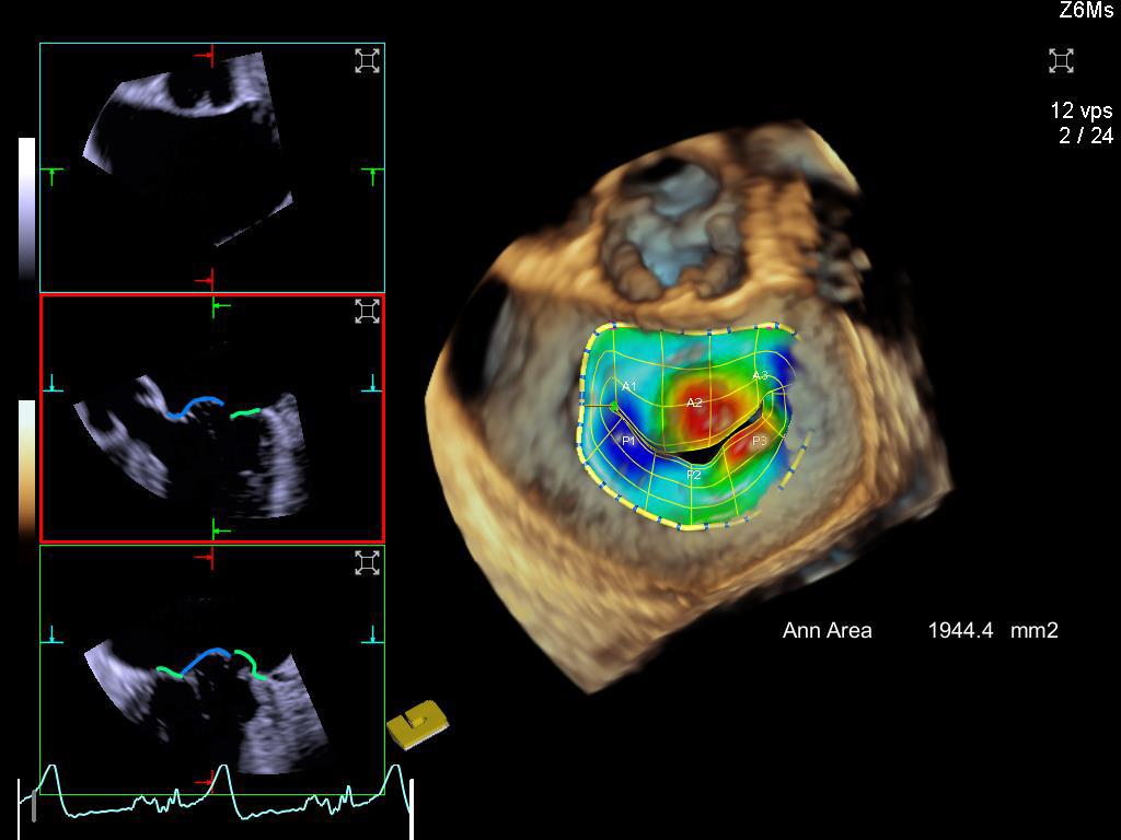 Mitral Valve