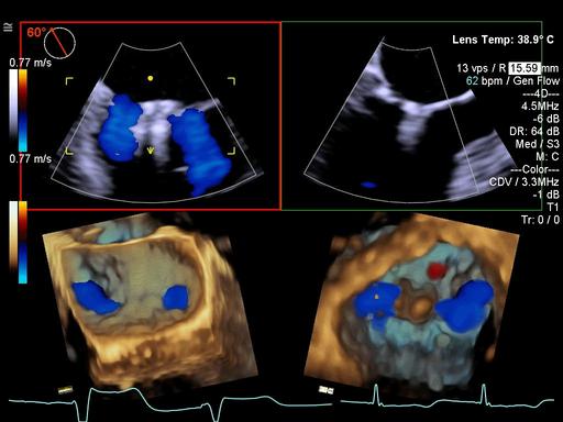 Advancing 3D TEE - Siemens Healthineers USA