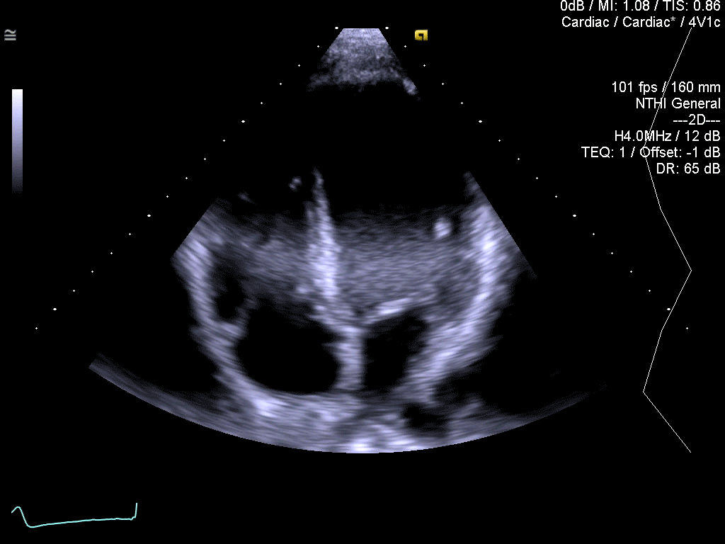 TEQ™  ultrasound technology