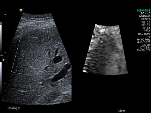 Elastografia por Ultrassom - Siemens Healthineers Brasil