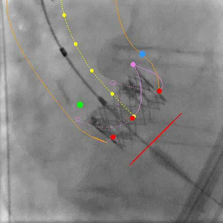 Siemens - Advanced Therapies - syngo Aortic Valve Guidance