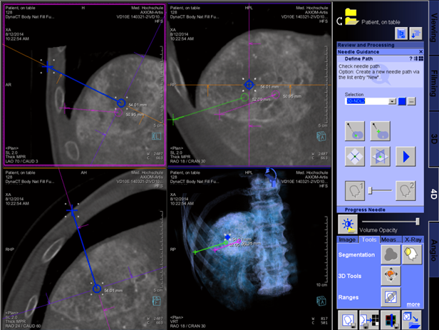 RFA cancer treatment needle path planning